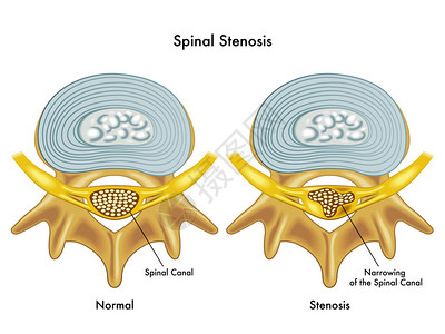 从医学角度说明脊椎萎缩图片
