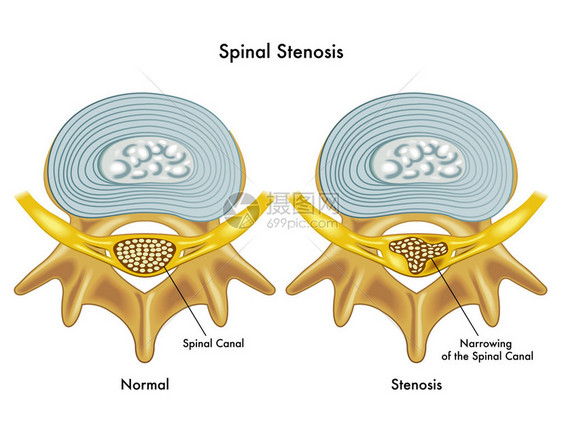 从医学角度说明脊椎萎缩图片
