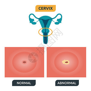 人类子宫颈结构说明正背景图片