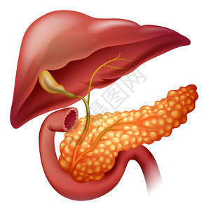 Pancreas癌症图片