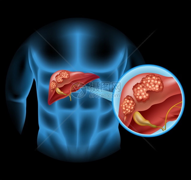 肝癌图详细说明图片