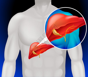 肝癌图详细说明图片