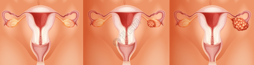 卵巢癌插图的三个阶段图片