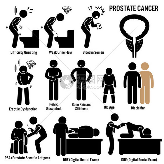 一组前列腺癌疾病的插图图片