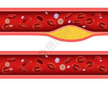 用坏胆固醇解剖术堵塞动图片