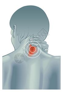 颈部僵硬症状的医学插图图片