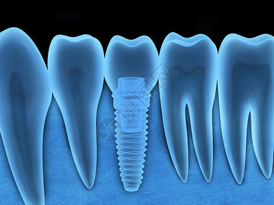 牙类人植入X射线在3d中背景图片