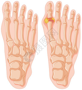 人脚趾痛风图解背景图片