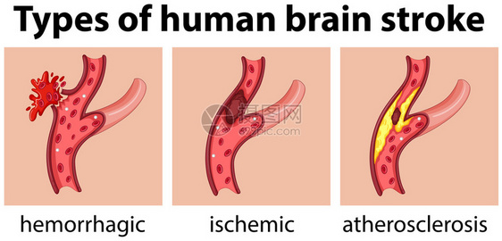 人脑中风图的类型图片