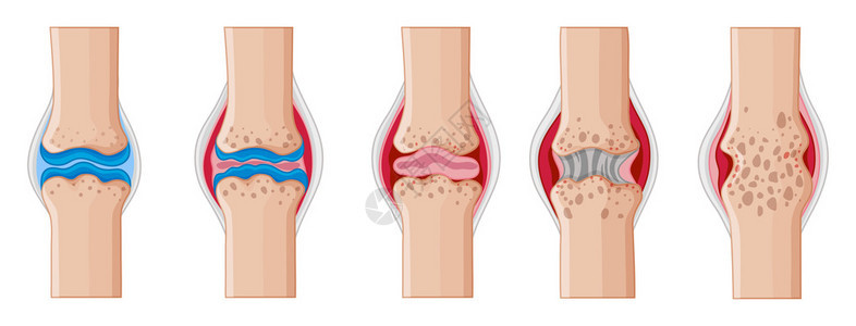 人体关节插图中的图片
