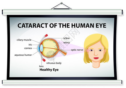 人眼插图中的白内障图图片