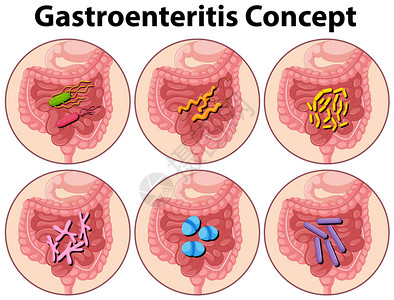 显示肠胃炎概念图的表图片