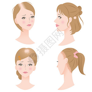 患有典型脱发的女会出现发际线后退头顶或侧面的秃斑图片