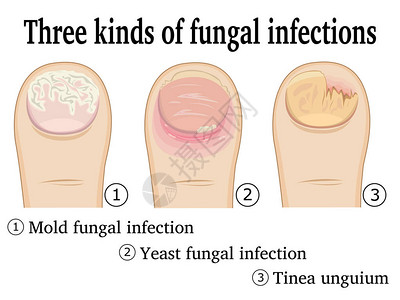 脚趾上的三种真菌感染图片