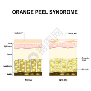 脂肪团也称为橘皮综合症健康的皮肤图片