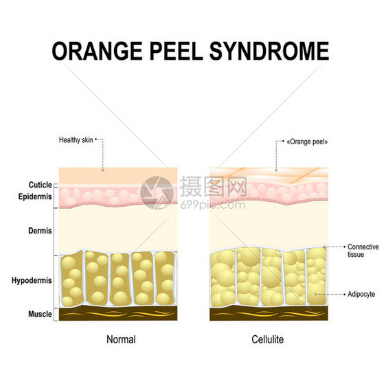 脂肪团也称为橘皮综合症健康的皮肤图片