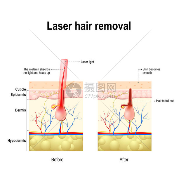 激光除毛激光产生的光束被头发中的色素吸收这会对毛囊造成伤害图片