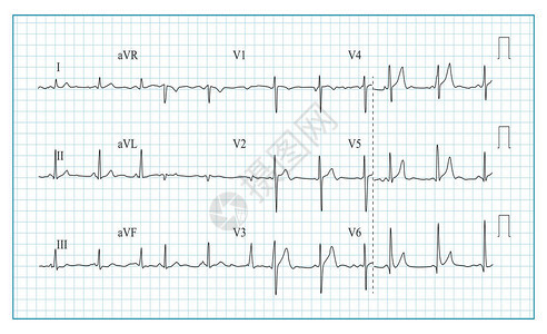 心脏电图表向量检查心电图上波形的插图心律图片