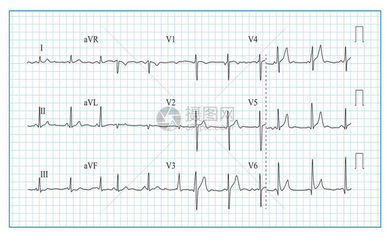 心脏电图表向量检查心电图上波形的插图心律图片