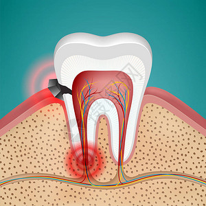 龋齿和疾病牙龈背景图片