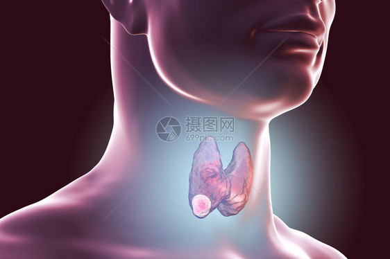 甲状腺癌3D图解显示人体内图片