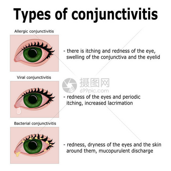 三种主要类型的结膜炎过敏图片