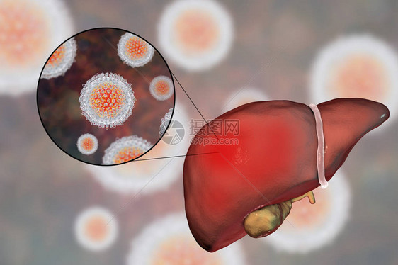 丙型肝炎感染的肝脏和丙型肝炎HCV的特写视图图片