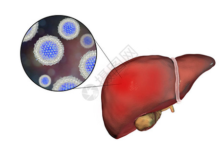 丙型肝炎感染的肝脏和丙型肝炎HCV的特写视图图片