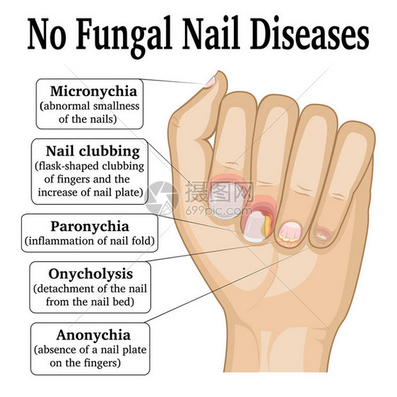 五种不同的非真菌指甲疾病的插图图片