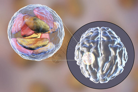 寄生虫原生动物刚地弓形虫引起的脑脓肿和脓肿腔内弓形虫寄生虫的特写视图图片