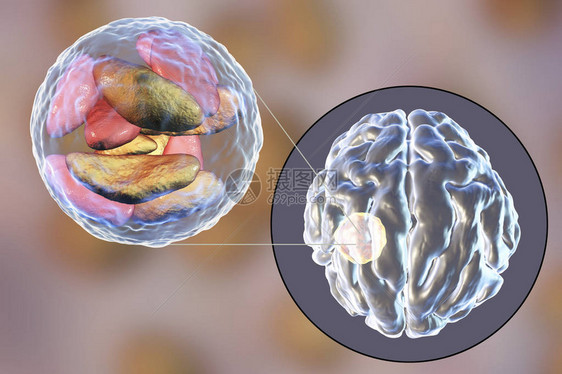 寄生虫原生动物刚地弓形虫引起的脑脓肿和脓肿腔内弓形虫寄生虫的特写视图图片