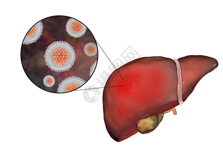 肝硬化阶段丙型肝炎感染的肝脏和丙型肝炎HCV3D插图片