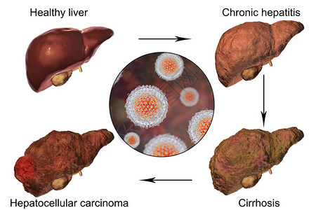 肝炎C感染的肝病例增图片