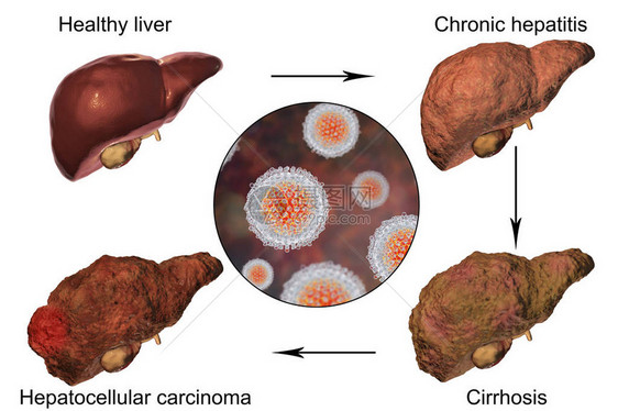 肝炎C感染的肝病例增图片