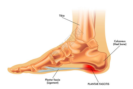 Plantar法西图片