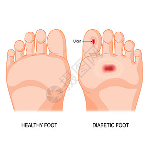 糖尿病足底病理男或女鞋底赤脚图片