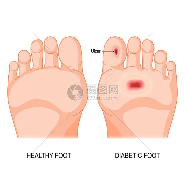 糖尿病足底病理男或女鞋底赤脚插画图片下载 正版图片 摄图网