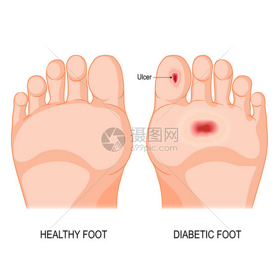 糖尿病足底病理男或女鞋底赤脚图片