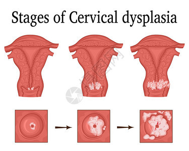 子宫颈痢疾的三阶段一种潜在背景图片