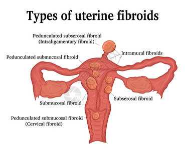 子宫肌瘤的类型例如壁内肌瘤浆膜下肌瘤图片