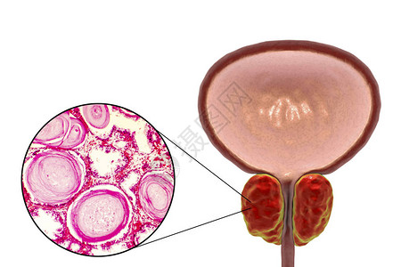 显微照片显示腺体扩张图片