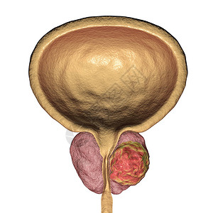 前列腺癌3D图解显示前列腺内有肿瘤图片