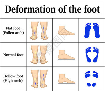 足部变形图解扁平足和空心足有脚印背景图片