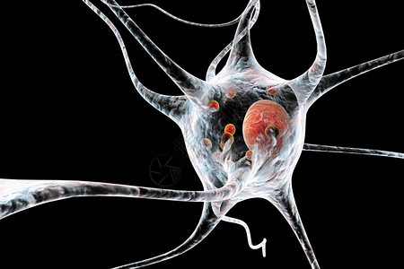 帕金森病3D插图显示含有路易体小红球的神经元图片