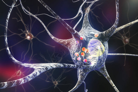 帕金森病3D插图显示含有路易体小红球的神经元背景图片