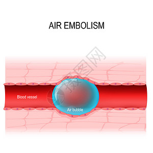 空气栓塞气体栓塞是血管阻塞图片