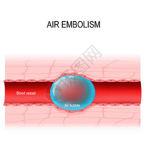 空气栓塞气体栓塞是血管阻塞背景图片