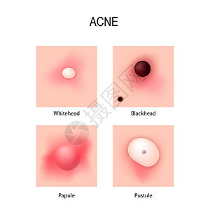 Acne粗俗发育阶段皮条类皮肤图片