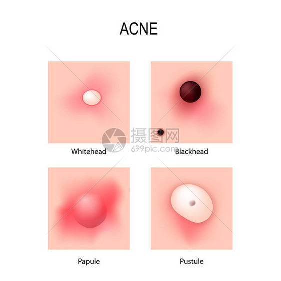 Acne粗俗发育阶段皮条类皮肤图片