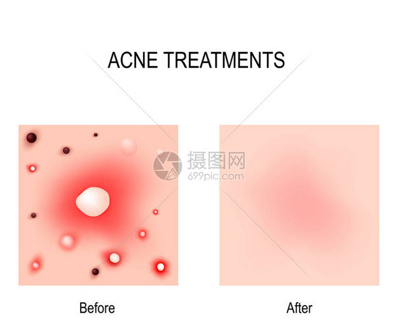 痤疮治疗之前和之后皮肤问题图片
